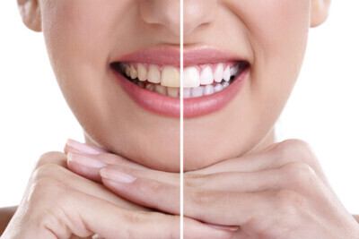 Blanqueamiento Dental en Casa vs Profesional