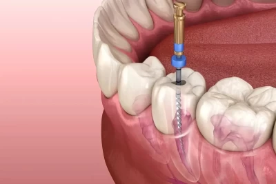 Endodoncia: Cómo Salvar un Diente Sin Dolor