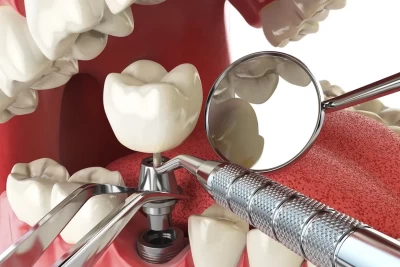 Implantes Dentales: Guía Completa, Precios y Cuidados